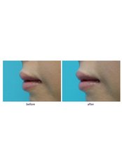 Lip Augmentation - SkinArt Group