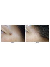 Mole Removal - SkinArt Group