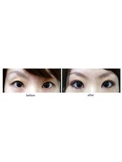 Eyelid surgery - SkinArt Group