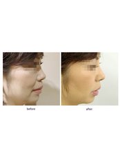 Non-Surgical Nose Job - SkinArt Group