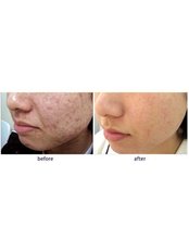 Acne Treatment - SkinArt Group