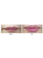 Lip Augmentation - SkinArt Group