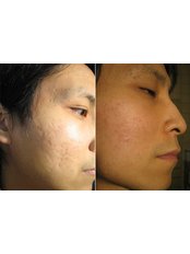 Acne Scars Treatment - SkinArt Group