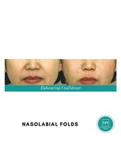 Nasolabial Folds Treatment - NextMed Clinic Cheras