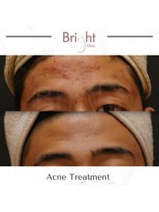 Acne Treatment - Bright Clinic