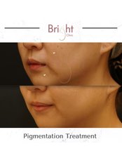 Pigmentation Treatment - Bright Clinic