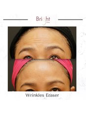 Treatment for Wrinkles - Bright Clinic