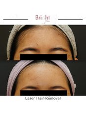 Laser Hair Removal - Bright Clinic
