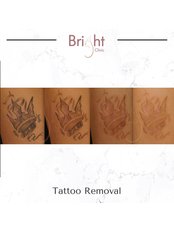 Tattoo Removal - Bright Clinic