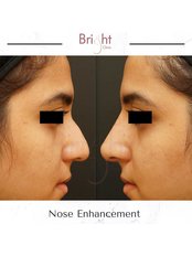 Non-Surgical Nose Job - Bright Clinic