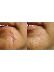 Acne Scars Treatment - Wai Clinic Subang