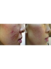 Scar Removal - CHIC Med-Aesthetic Clinics