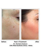 Age Spots Removal - CHIC Med-Aesthetic Clinics