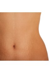 Stretch Marks Removal - CHIC Med-Aesthetic Clinics