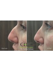 Non-Surgical Nose Job - CHIC Med-Aesthetic Clinics