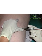 Sclerotherapy - CHIC Med-Aesthetic Clinics