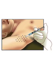 Excessive Sweating Treatment - CHIC Med-Aesthetic Clinics