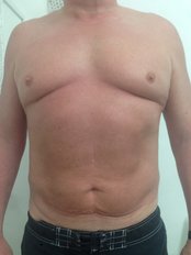 Vaser Assisted Liposuction - St. Mary's Clinic