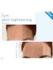 Laser Skin Tightening - The Skin Studio