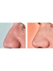 Non-Surgical Nose Job - Arya Beauty & Skin Care