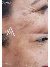 Treatment for Wrinkles - Arya Beauty & Skin Care