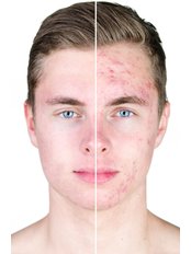 ACNE - Health And Beauty For You