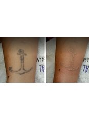 Tattoo Removal - MDSKIN Skin Care Center
