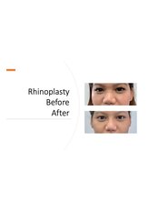 Rhinoplasty - Alabang Aesthetic Clinic