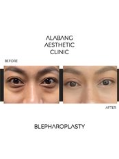 Blepharoplasty - Alabang Aesthetic Clinic