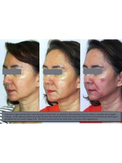 Dermal Fillers - The Treatment for Lines and Wrinkles Clinic