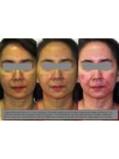 Dermal Fillers - The Treatment for Lines and Wrinkles Clinic