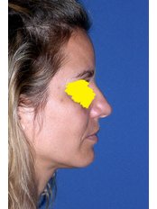 Before Rhinoplasty - The Treatment for Lines and Wrinkles Clinic