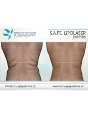 Laser Assisted Liposuction - UP HPA