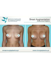 Breast Implants - UP HPA