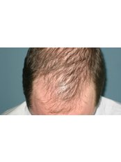 Treatment for Male Pattern Baldness - Dr Tyng Tan Aesthetics and Hair Clinic