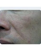 Renew Skin Pores - Yume Aesthetic Clinic