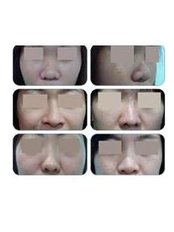 Fillers Nose - Yume Aesthetic Clinic