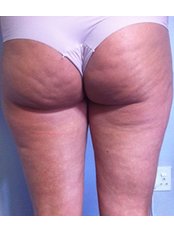 Cellulite Treatment - Pulse Dermatology and Laser