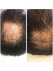 Hair Loss Treatment - Pulse Dermatology and Laser