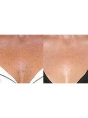 IPL Pigmentation and Vein removal  - Pulse Dermatology and Laser