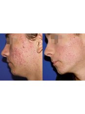 Acne Treatment - Pulse Dermatology and Laser