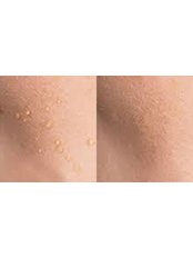 Skin Tag Removal - Pulse Dermatology and Laser