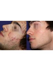 Acne Treatment - Pulse Dermatology and Laser