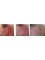 Laserderm Rynfield - Wound Healing- Carboxy Therapy 