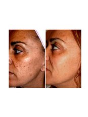 IPL Skin Rejuvenation - Shaping You Laser Studio
