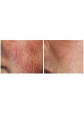 Laser and Pulsed Light Vein Treatment - Shaping You Laser Studio
