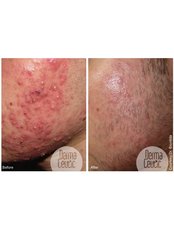 Acne Scars Treatment - Skin4u
