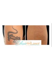 Tattoo Removal - Classic Laser SA