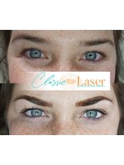 Permanent Makeup - Classic Laser SA