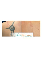 Tattoo Removal - Classic Laser SA